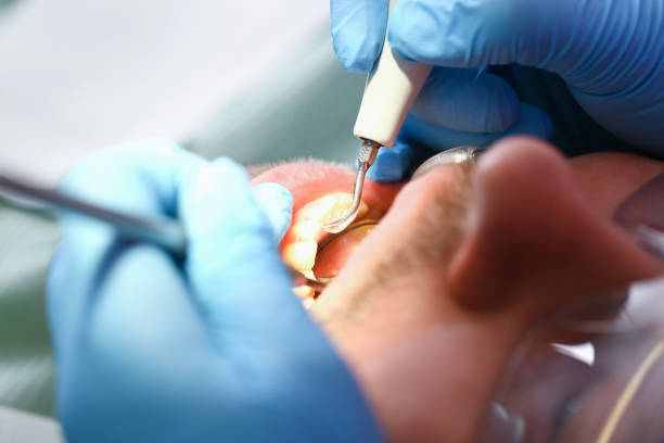 Best Knocked-Out Tooth Emergency  in East San Gabriel, CA